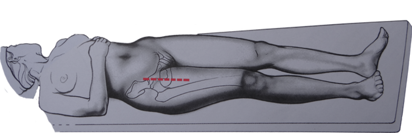 Imagem Abordagem Posterior
